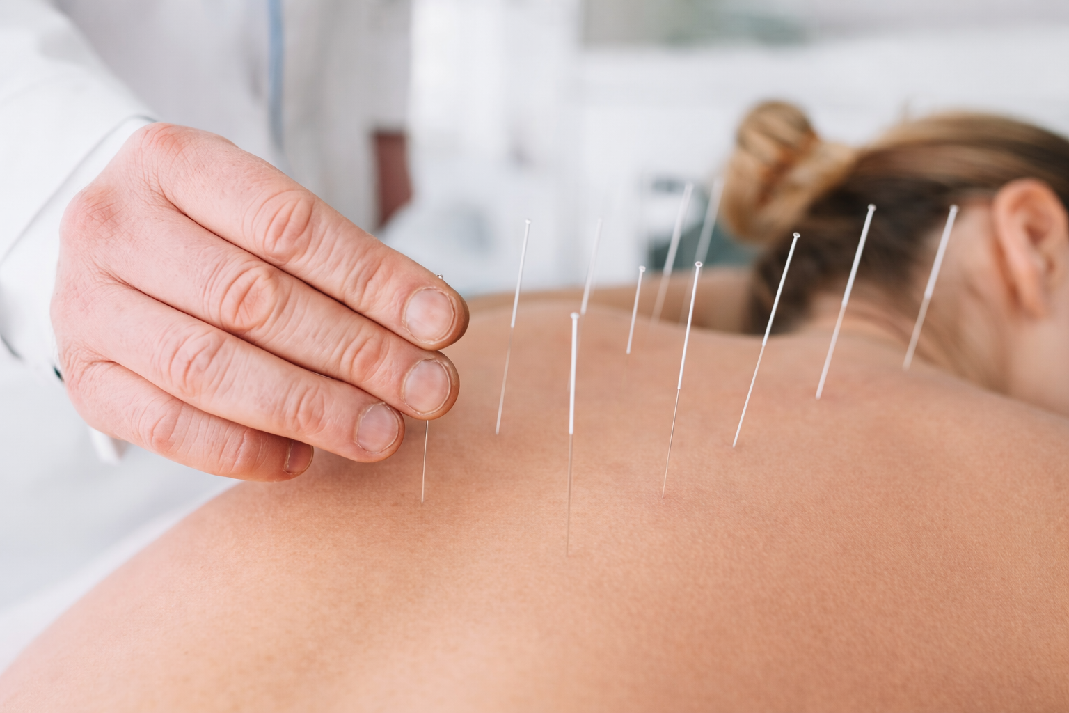 Sessão de Acupuntura no Vital Kali Vila Tolstoi - Tratamento terapêutico para dores e equilíbrio energético