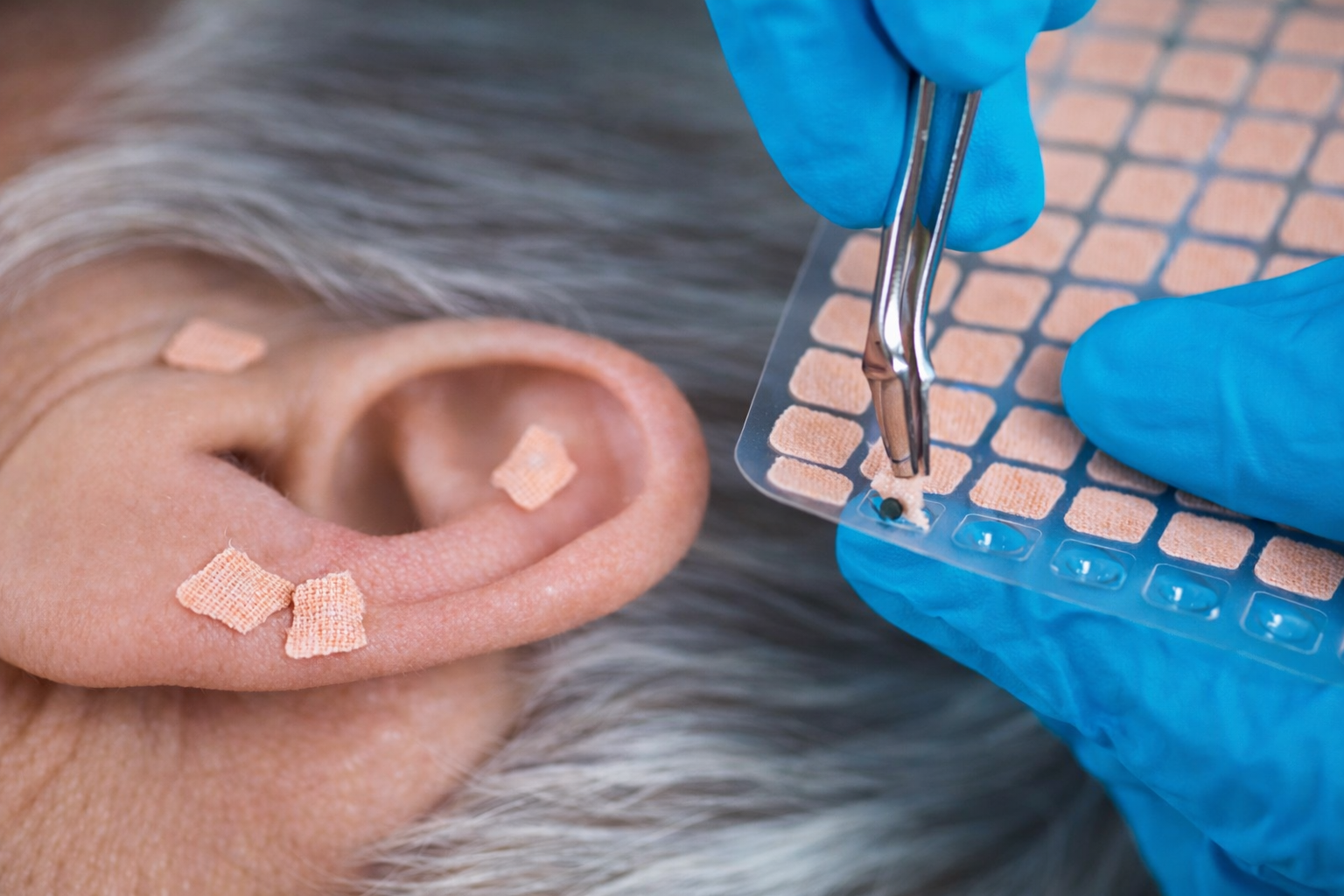 Auriculoterapia com pontos reflexos na orelha para ansiedade e estresse