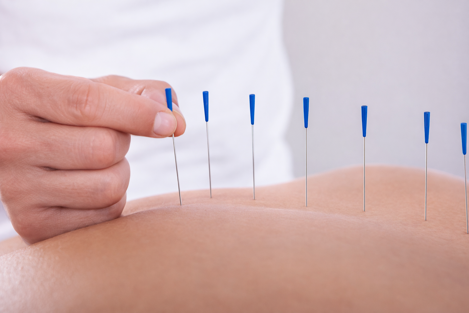 Acupuntura Sistêmica com agulhas finíssimas para alívio de dores